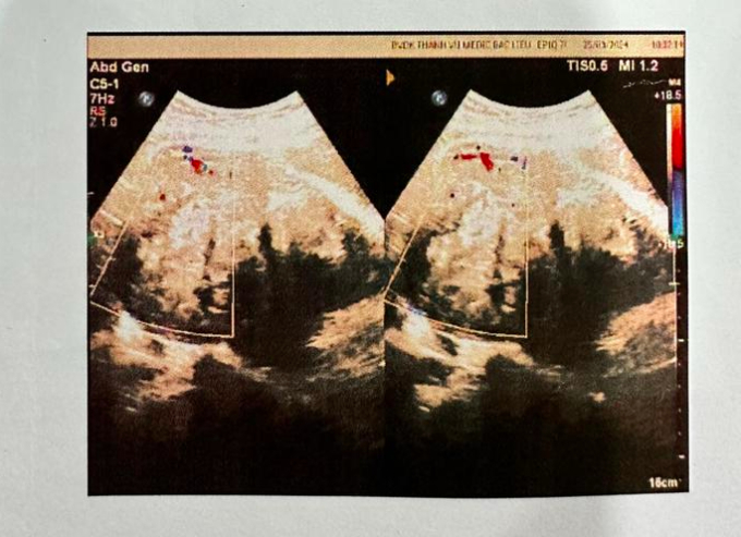 Người phụ nữ ở Bạc Liêu bỗng đau bụng dữ dội, phẫu thuật lấy ra được một thứ nặng đến 900 gram-1