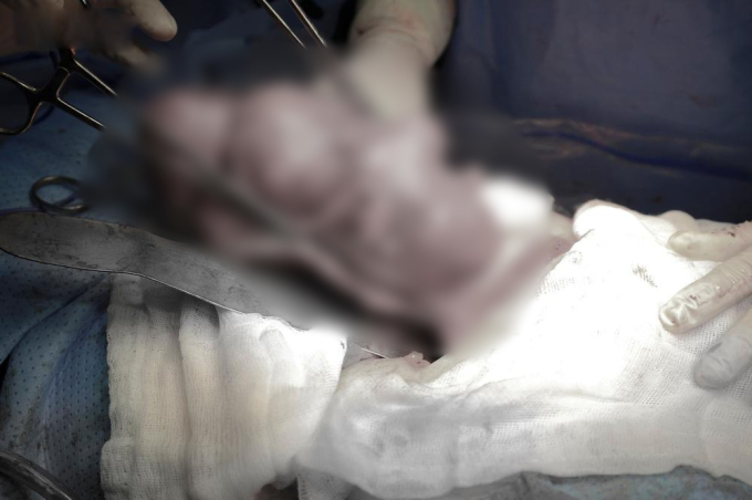 Người phụ nữ ở Bạc Liêu bỗng đau bụng dữ dội, phẫu thuật lấy ra được một thứ nặng đến 900 gram-3