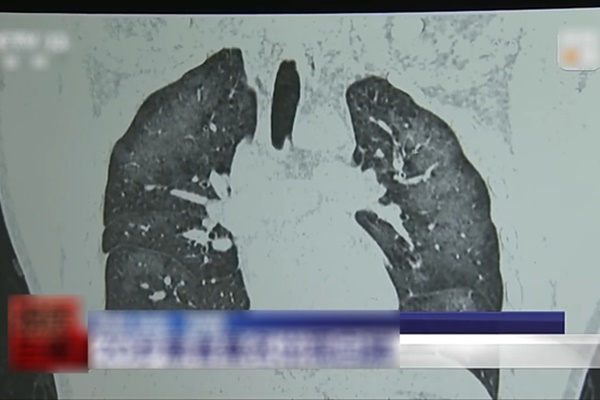 Chàng trai 20 tuổi phổi trắng xóa vì chiêu chống nắng của nhiều người-1