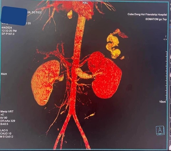 Nam sinh bị bạn đâm thủng thận-2