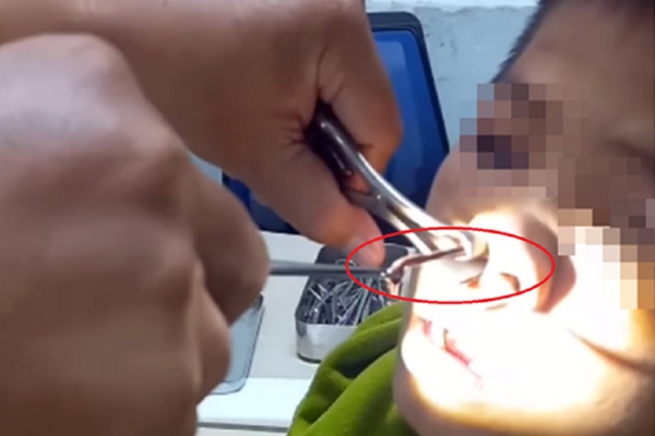 Con vắt rừng dài 8cm sống 10 ngày trong mũi của bệnh nhân-1