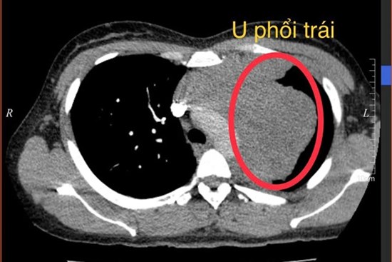 Người phụ nữ mắc ung thư ở tuổi 34, BS nghi ngờ nguyên nhân đến từ 1 thói quen của chồng
