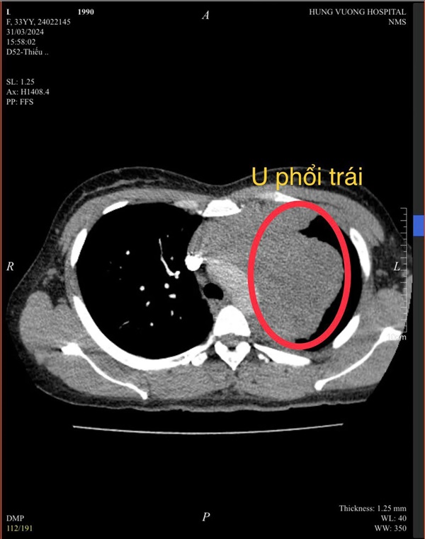 Người phụ nữ mắc ung thư ở tuổi 34, BS nghi ngờ nguyên nhân đến từ 1 thói quen của chồng-1