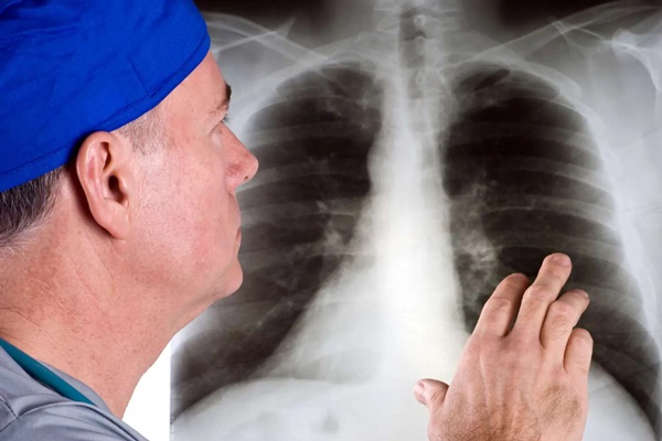 Không bao giờ hút thuốc vẫn có thể bị ung thư phổi: Đây là 11 dấu hiệu cảnh báo nguy hiểm-1