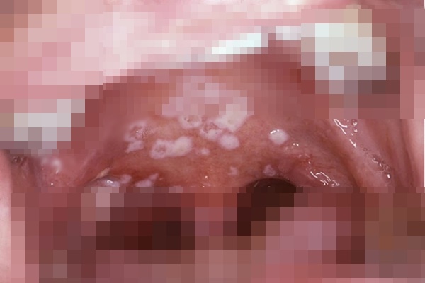 Khoang miệng người phụ nữ nở hoa” trắng xóa, đau đớn vì nhiễm loại nấm tưởng chỉ có ở vùng kín-1