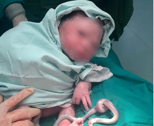 Có thể sinh thường khi dây rốn quấn cổ thai nhi?-1