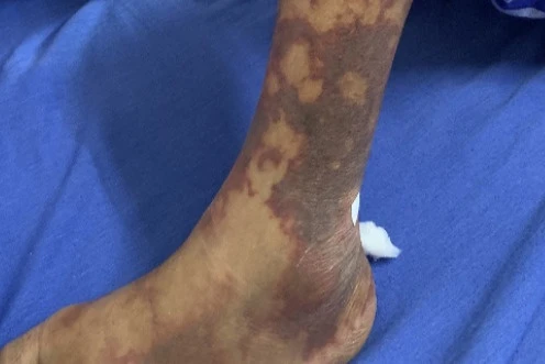 Nhiễm liên cầu lợn vì mê món đặc sản-1