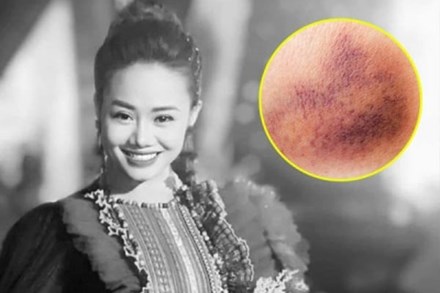 Ca sĩ Lương Ngọc Diệp qua đời ở tuổi 37: Nhận diện vết bầm tím bất thường cảnh báo ung thư