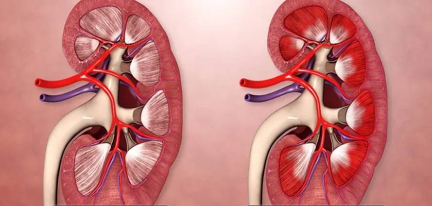 5 điều khiến thận suy hỏng nhanh hơn nhưng nhiều người hay làm ngơ”-3