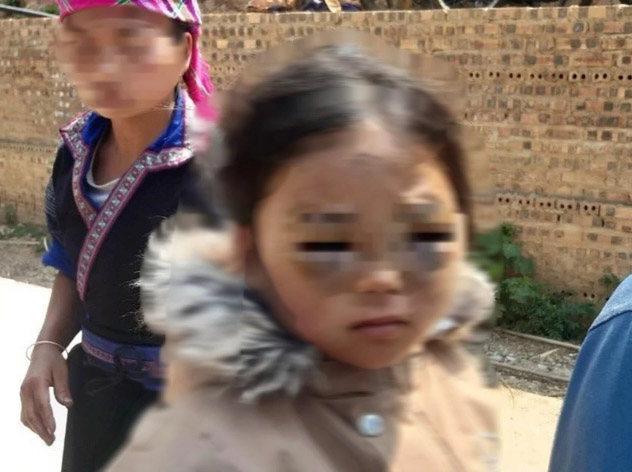 Vụ bé lớp 1 ở Yên Bái bị đánh tím mắt: Thông tin bất ngờ về cô giáo-2