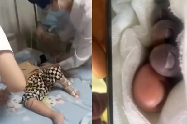 Bé trai 2 tuổi nhiễm vi khuẩn ăn thịt người, phải cắt cụt chi vì nghịch cá ở chợ-1