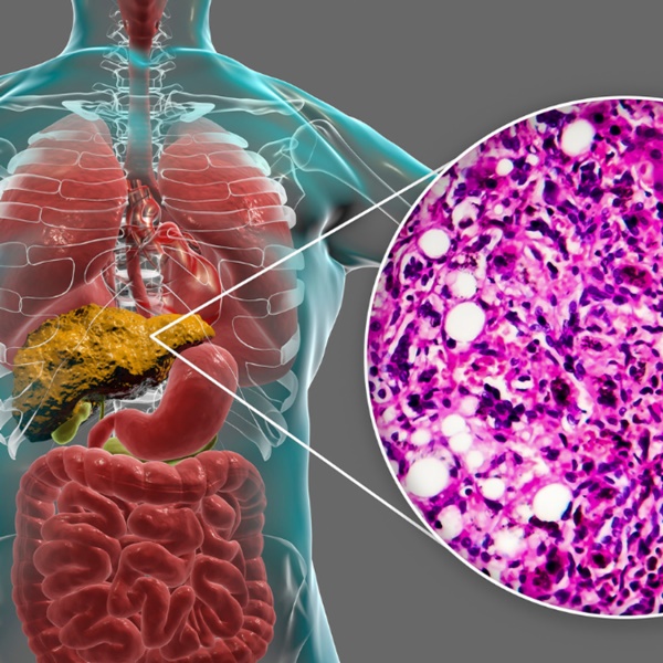 Gan bị đầu độc” vì thói quen giải khát sai lầm của nhiều người Việt-1