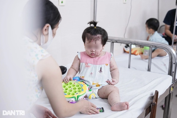 Tay chân miệng tại Hà Nội vào đỉnh dịch: Triệu chứng nguy hiểm nhất-1