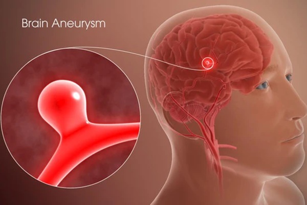 Người đàn ông suýt chết sau một cơn đau đầu: BS cảnh báo người có 1 trong 7 đặc điểm này cần cẩn trọng-2