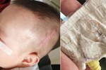 Y tá ‘quên’ ống luồn kim trong đầu em bé, 5 năm sau nó trôi xuống cổ