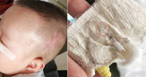 Y tá ‘quên’ ống luồn kim trong đầu em bé, 5 năm sau nó trôi xuống cổ-1