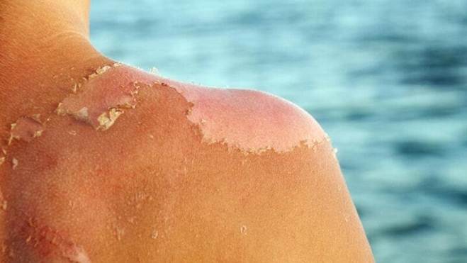 Cách chữa da cháy nắng sau khi tắm biển ngày hè-1