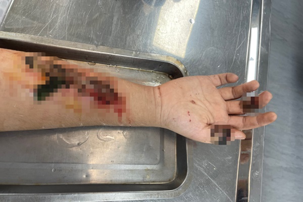 Tay của nam thanh niên chảy mủ, có nguy cơ hoại tử vì cách chữa bệnh tại nhà của nhiều người-1