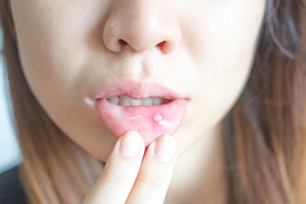 3 bất thường ở khoang miệng là cảnh báo sớm khi tế bào ung thư tấn công cơ thể-2