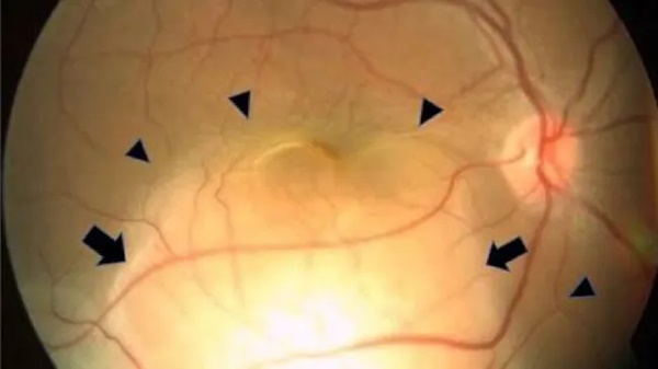 Người phụ nữ phát hiện ung thư phổi ẩn giấu nhờ 1 dấu hiệu ở mắt-1