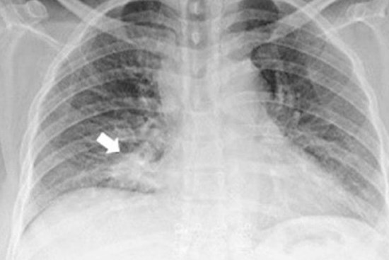 Người phụ nữ phát hiện ung thư phổi ẩn giấu nhờ 1 dấu hiệu ở mắt