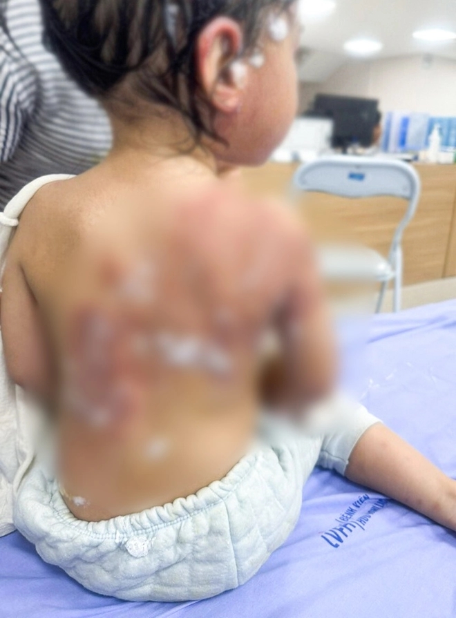 Bị đổ cả chai nước thông cống lên người, bé gái 25 tháng tuổi bỏng nặng-1