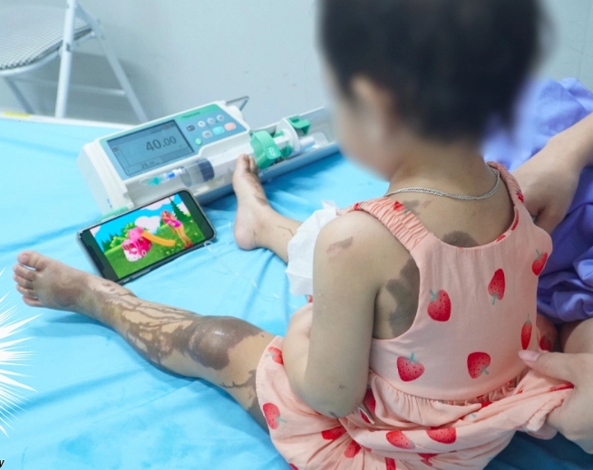 Bị đổ cả chai nước thông cống lên người, bé gái 25 tháng tuổi bỏng nặng-2