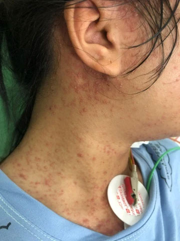 Cô gái suýt mất mạng vì căn bệnh quen thuộc-1