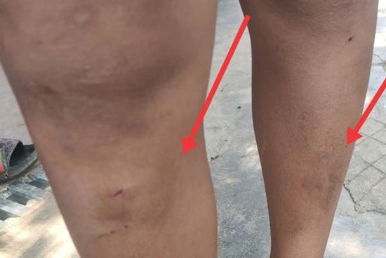 Ném đá văng vào nhà hàng xóm, 5 cháu nhỏ bị đánh bầm tím