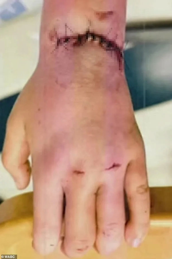 Cửa thang máy vừa mở, tay cô bé 5 tuổi bị hút vào khe cửa, người thân hoảng loạn giải cứu-1