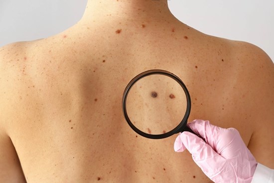 Rùng mình trước clip mô tả dấu hiệu cảnh báo ung thư ác tính, có thể xuất hiện trên da trước 10 năm