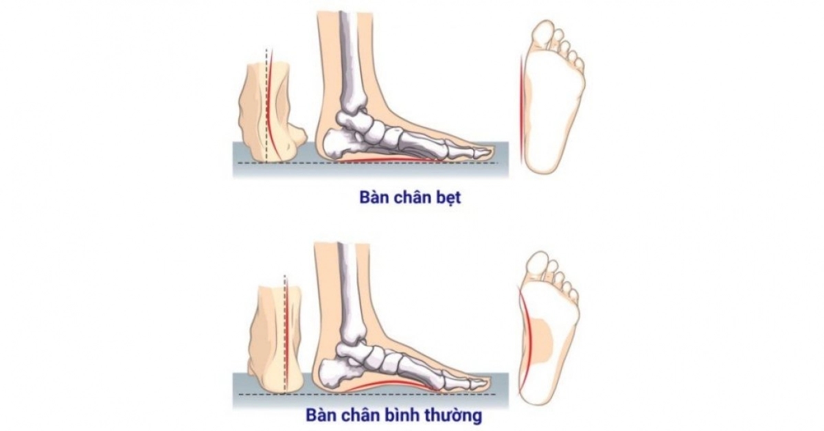 Hội chứng bàn chân bẹt ở trẻ nhỏ-1