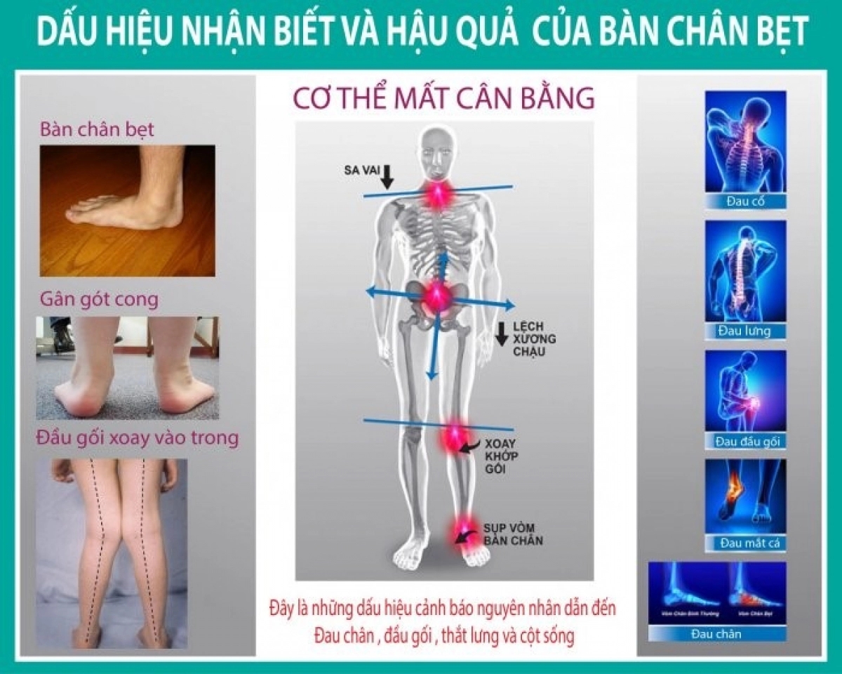 Hội chứng bàn chân bẹt ở trẻ nhỏ-2