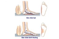 Hội chứng bàn chân bẹt ở trẻ nhỏ