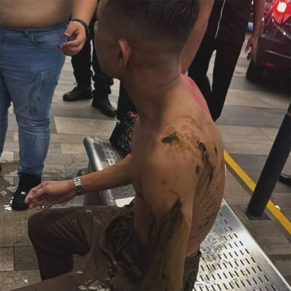 Đã bắt được nghi phạm tạt axit cầu thủ Malaysia, nhìn hình ảnh da bong tróc khiến ai cũng rùng mình-1