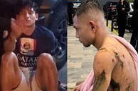 Đã bắt được nghi phạm tạt axit cầu thủ Malaysia, nhìn hình ảnh da bong tróc khiến ai cũng rùng mình