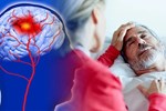 Người đàn ông 53 tuổi liệt nửa người, đột quỵ não giữa đêm: BS chỉ ra ngay 2 thói quen làm tăng nguy cơ