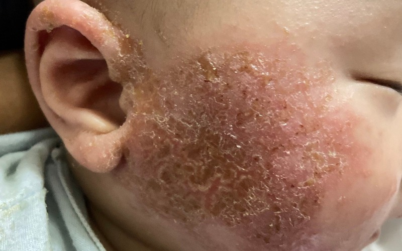 Tự tắm lá thuốc tại nhà, bé 3 tháng tuổi bị viêm da nhiễm trùng-1