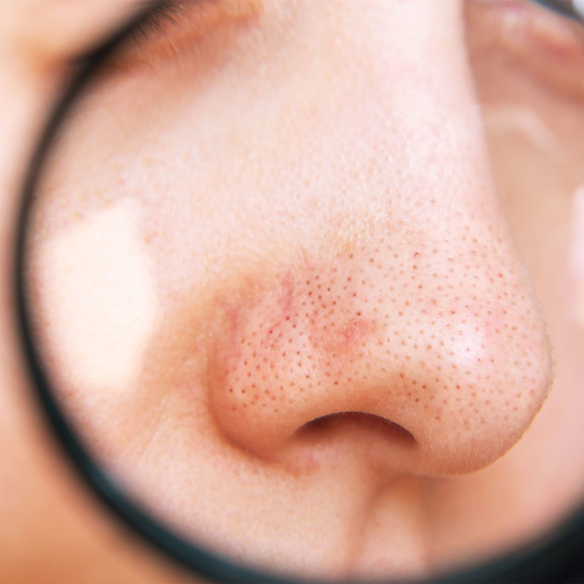 Những sai lầm khi xử lý mụn đầu đen-1