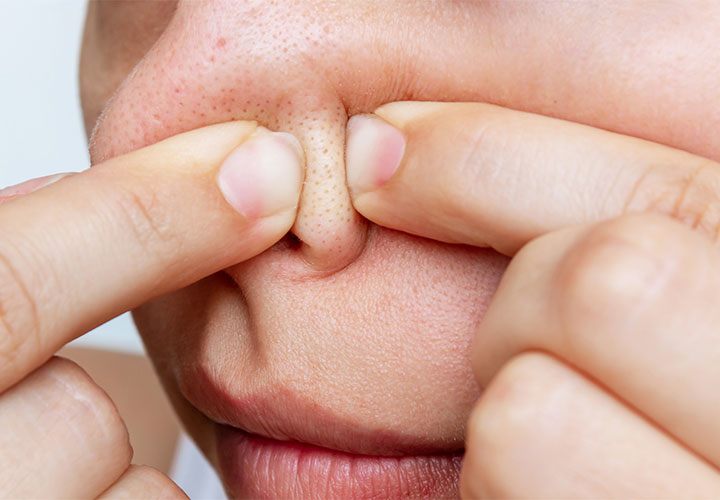 Những sai lầm khi xử lý mụn đầu đen-2