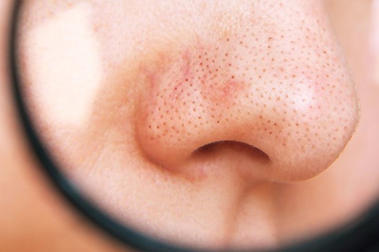 Những sai lầm khi xử lý mụn đầu đen