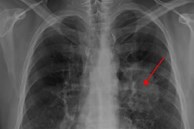 Người phụ nữ 37 tuổi qua đời sau 2 tuần phát hiện ung thư phổi, bác sĩ cảnh báo 1 dấu hiệu hầu hết mọi người đều bỏ qua
