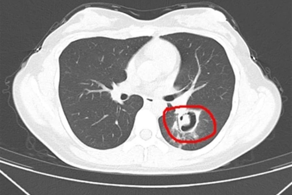Từ một nốt nhọt da, bé trai 11 tuổi bị viêm phổi hoại tử nặng-2