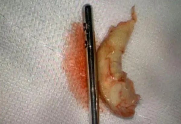 Đột quỵ 2 lần trong nửa năm, mỡ đóng thành tảng lớn vì uống 1 thứ như nước lọc-2