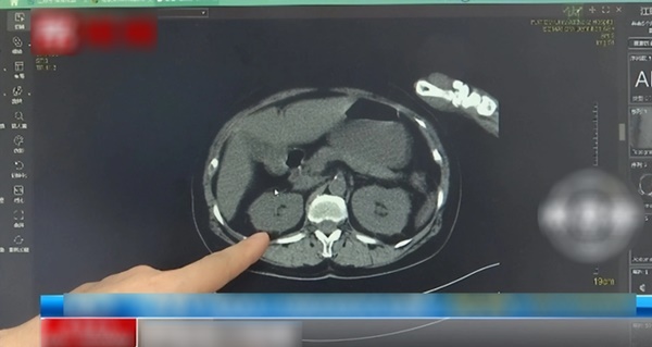 Cô gái bị nhiễm trùng toàn thân do lười làm 1 việc, nhiều người cũng vậy-2