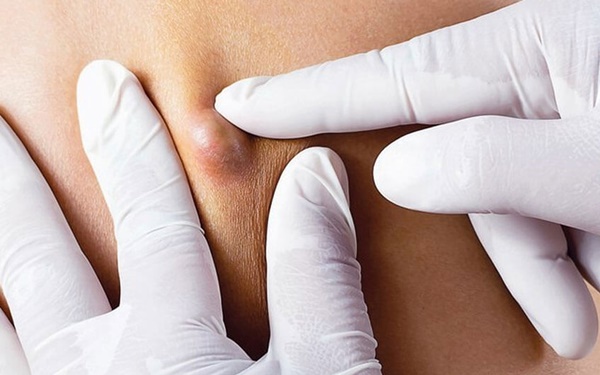 10 vị trí trên cơ thể có thể mọc nang và những điều cần biết-1