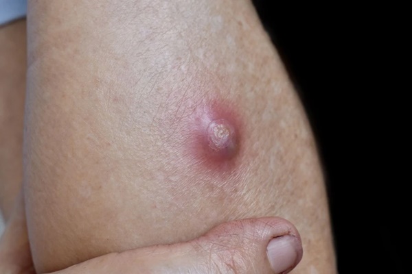 10 vị trí trên cơ thể có thể mọc nang và những điều cần biết-2