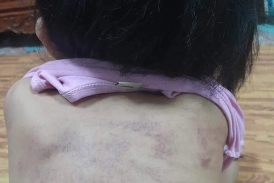 Bé 5 tuổi tím bầm lưng: Phân công 3 giáo viên phụ trách lớp làm nhiệm vụ khác