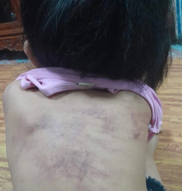 Bé 5 tuổi tím bầm lưng: Phân công 3 giáo viên phụ trách lớp làm nhiệm vụ khác-1