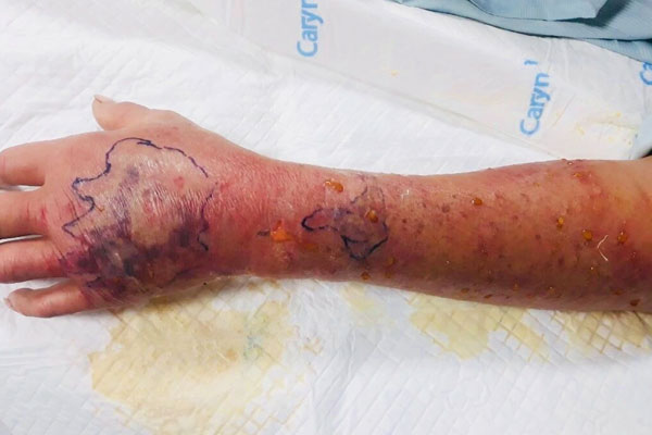 Bị trẻ 3 tuổi cắn, người đàn ông sốt cao, nhập viện-1